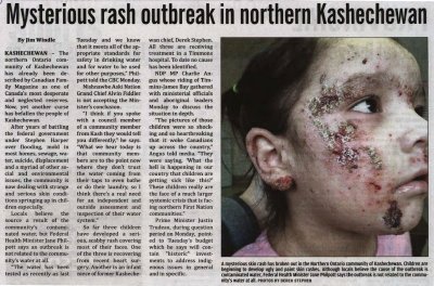 &quot;Mysterious rash outbreak in Northern Kashechewan&quot;